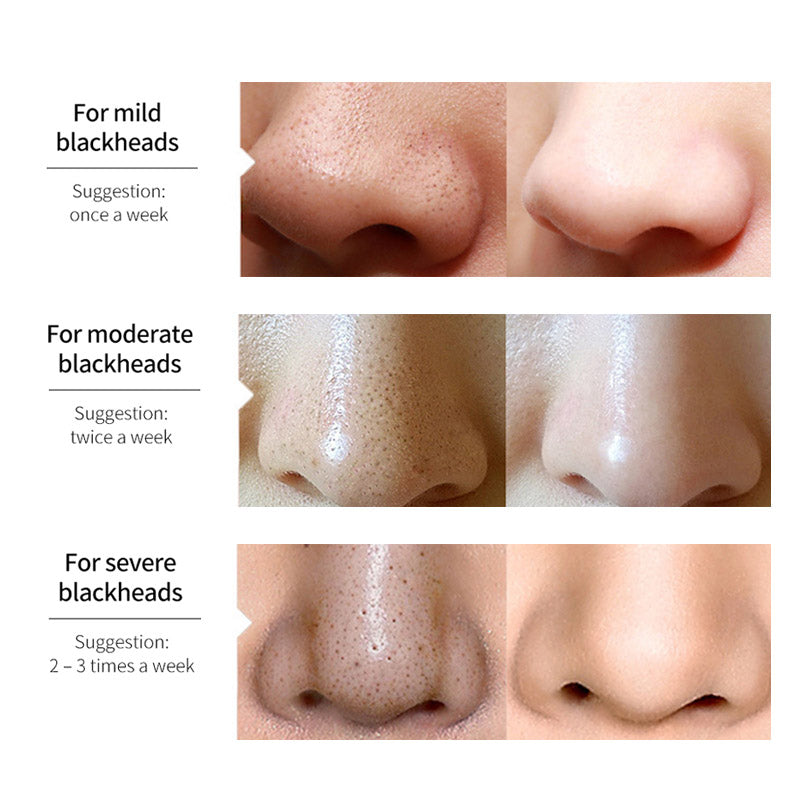Lanbena Blackhead Remover™ (1+1 GRATIS)