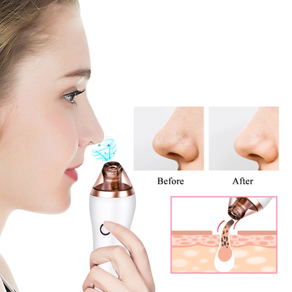 Clearskin | Blackhead Verwijderaar
